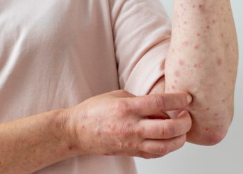 Sarampo em Portugal: Doença está a crescer em toda a Europa e já chegou a território português